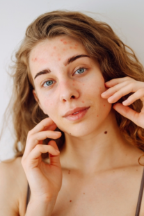 How your health gives you acne